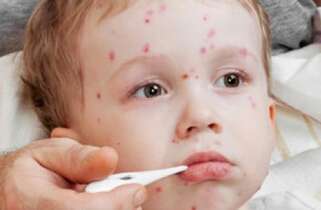 Maladies infantiles – La varicelle