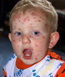 Comment diagnostiquer et traiter les éruptions cutanées chez l’enfant ?
